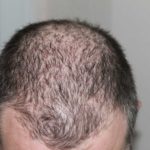 Bockshornklee als Mittel gegen Haarausfall